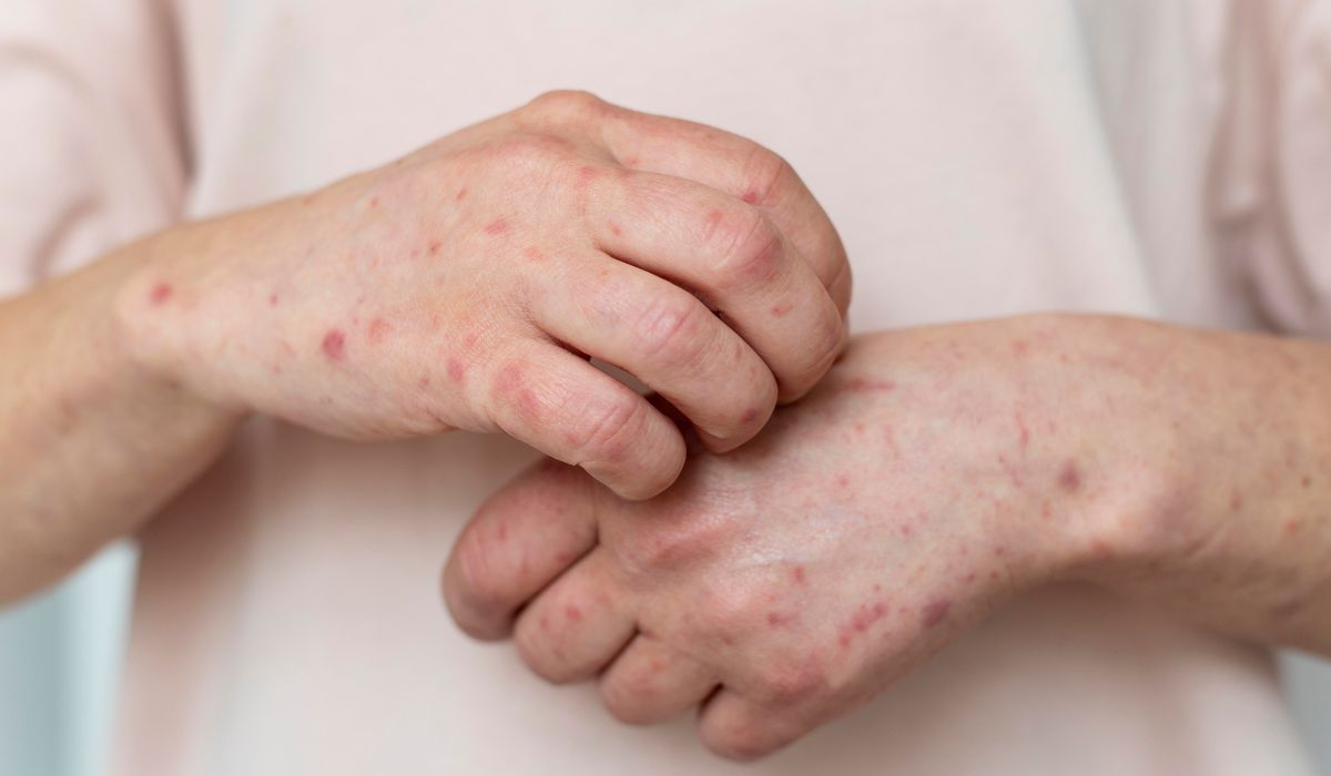 O Espírito Santo confirmou o segundo caso de Mpox em 2026. Foto: Freepik