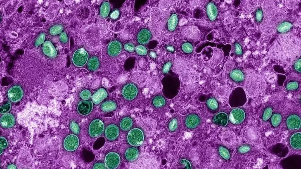 Casos confirmados de mpox no Brasil aumentam para 140 em 2026, segundo o Ministério da Saúde.