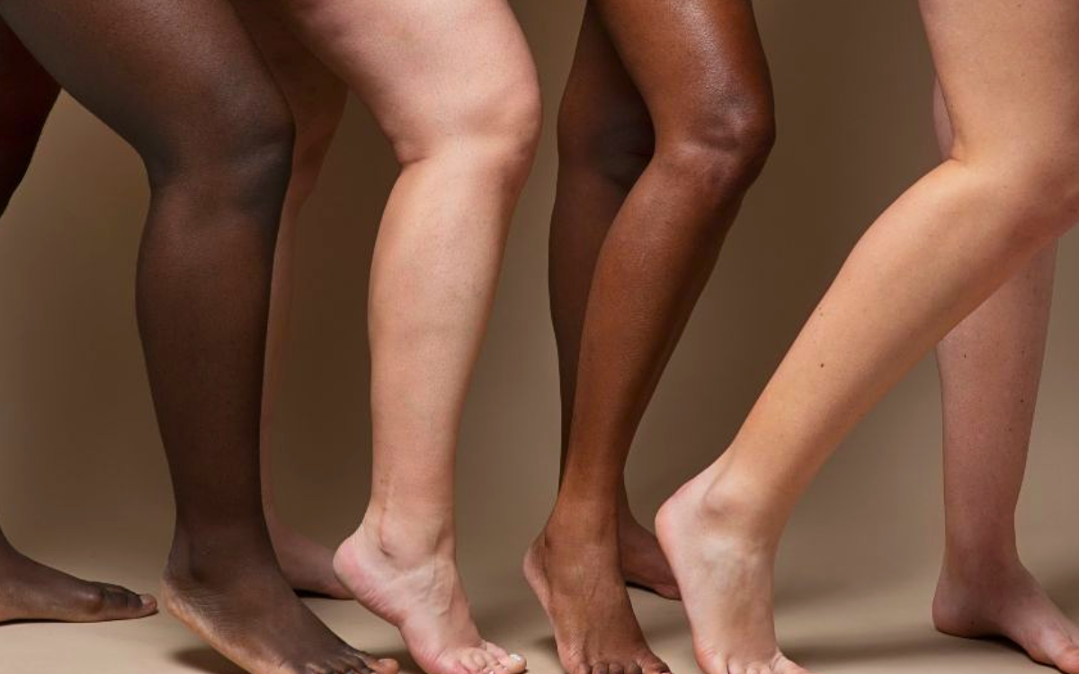 Lipedema: condição que afeta principalmente as pernas, causando dor, inchaço e sensibilidade, e impactando a qualidade de vida das pacientes. Foto: Pexels
